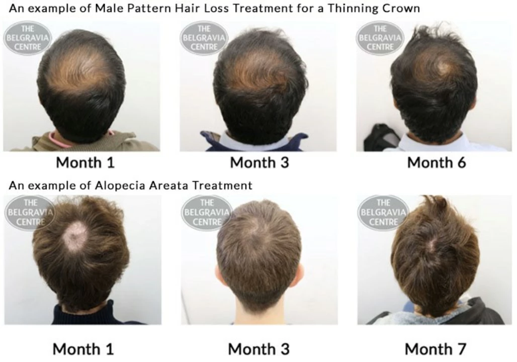 The Pros and Cons of Using Finasteride for Hair Loss Treatment