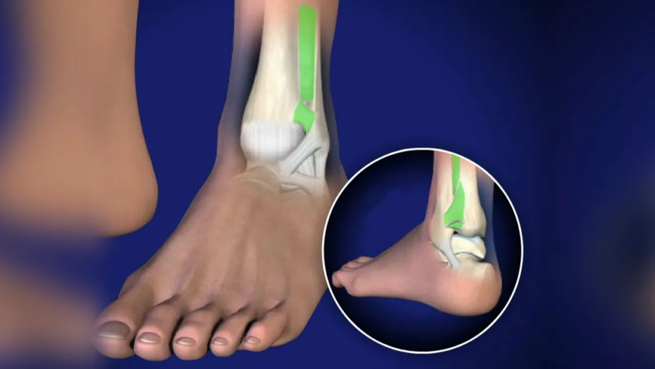Understanding High Ankle Sprains and Their Unique Treatment Needs