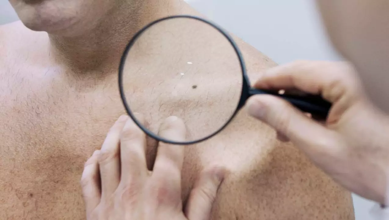 How to Spot Actinic Keratosis Early: A Guide for Self-Examination