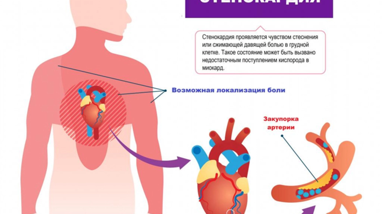 The use of isosorbide dinitrate in managing variant angina